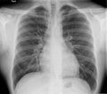 Apical pneumothorax (Radiopaedia 46001).jpg