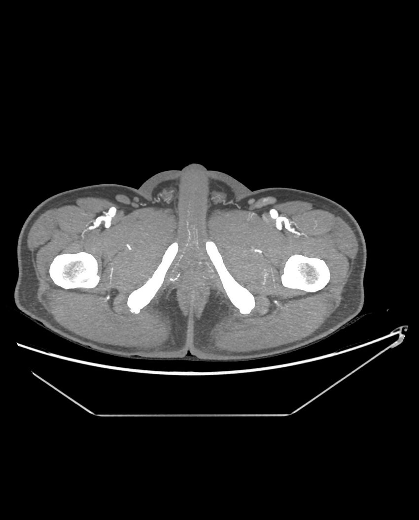 Aplastic posterior tibial arteries (Radiopaedia 84021-99249 A 109).jpg