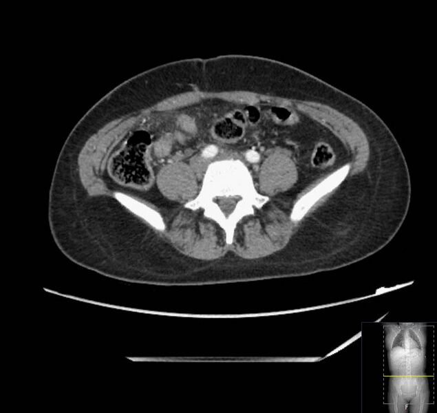 File:Appendicitis (CT angiogram) (Radiopaedia 154713-127660 Axial 33).jpg