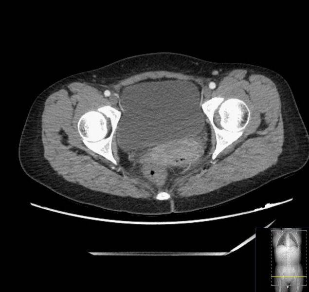 File:Appendicitis (CT angiogram) (Radiopaedia 154713-127660 Axial 64).jpg