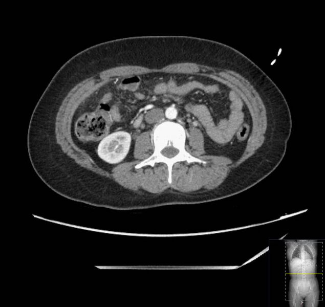 File:Appendicitis (CT angiogram) (Radiopaedia 154713-127660 Axial 83).jpg