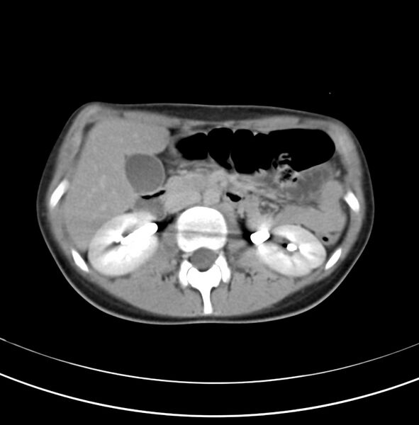 File:Appendicitis and incidental bicornuate uterus (Radiopaedia 22833-22853 Axial C+ delayed 11).jpg
