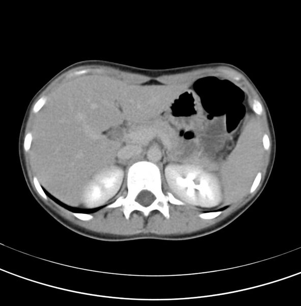 File:Appendicitis and incidental bicornuate uterus (Radiopaedia 22833-22853 Axial C+ delayed 6).jpg