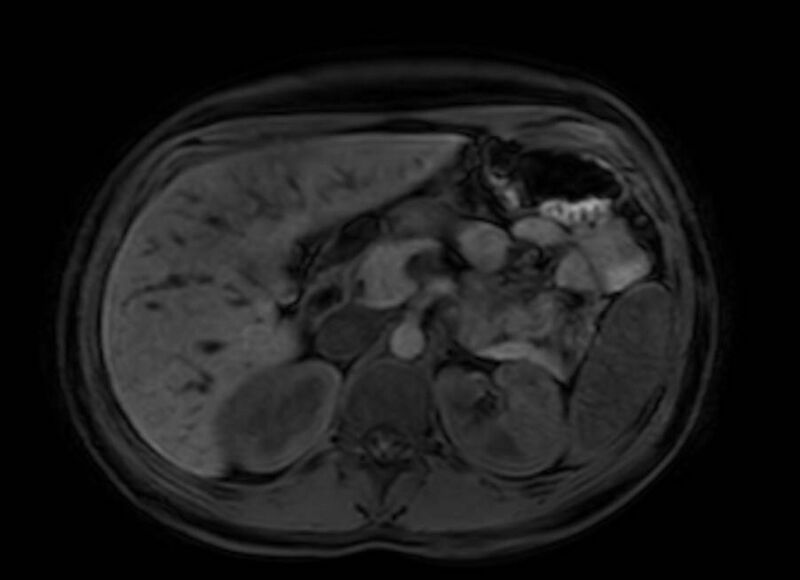File:Appendicitis in gravida (MRI) (Radiopaedia 89433-106395 Axial DIXON 37).jpg