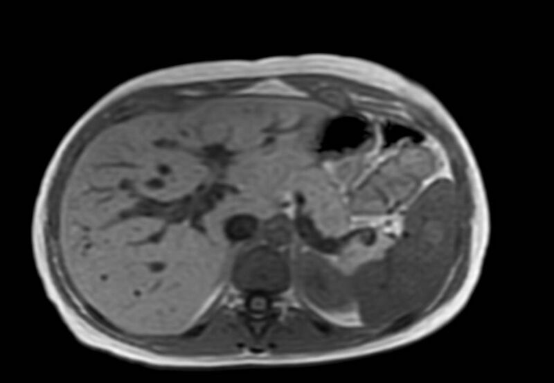File:Appendicitis in gravida (MRI) (Radiopaedia 89433-106395 Axial T1 in-phase 12).jpg