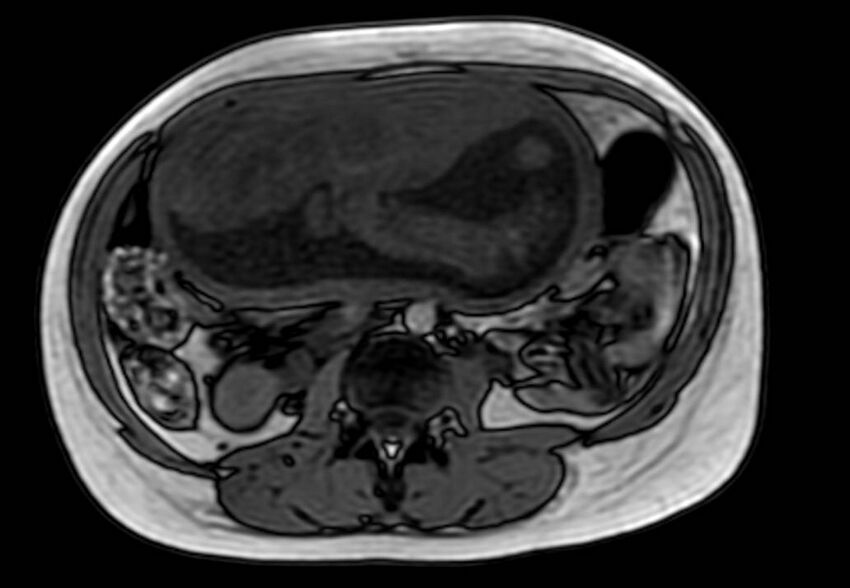 Appendicitis in gravida (MRI) (Radiopaedia 89433-106395 D 32).jpg