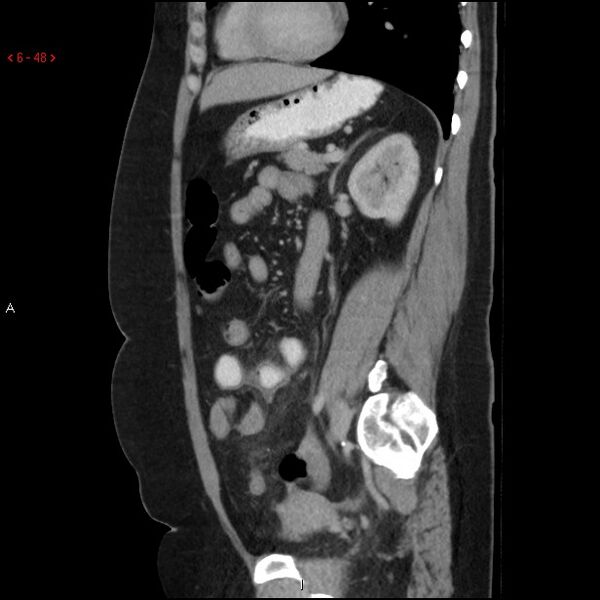 File:Appendicitis with microperforation- promontoric type (Radiopaedia 27268-27442 A 33).jpg