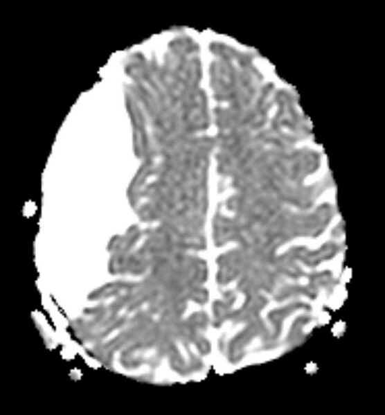 File:Arachnoid cyst- extremely large (Radiopaedia 68741-78451 Axial ADC 19).jpg