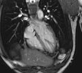 Arrhythmogenic right ventricular cardiomyopathy (Radiopaedia 39806-42237 D 132).jpg