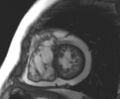 Arrhythmogenic right ventricular cardiomyopathy (Radiopaedia 69431-79307 Short axis cine 73).jpg