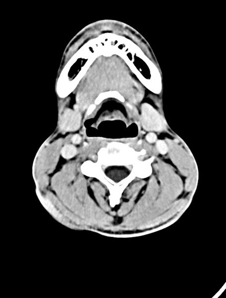 File:Arrow injury to the face (Radiopaedia 73267-84011 Axial C+ delayed 12).jpg