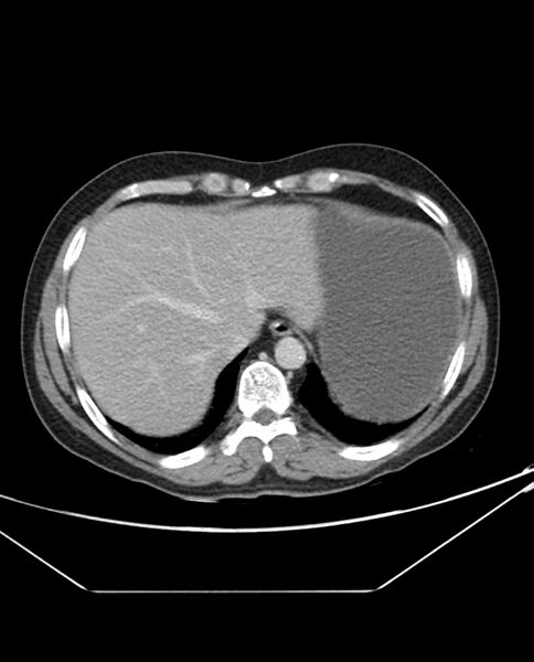File:Arterial occlusive mesenteric ischemia (Radiopaedia 84641-100054 A 14).jpg