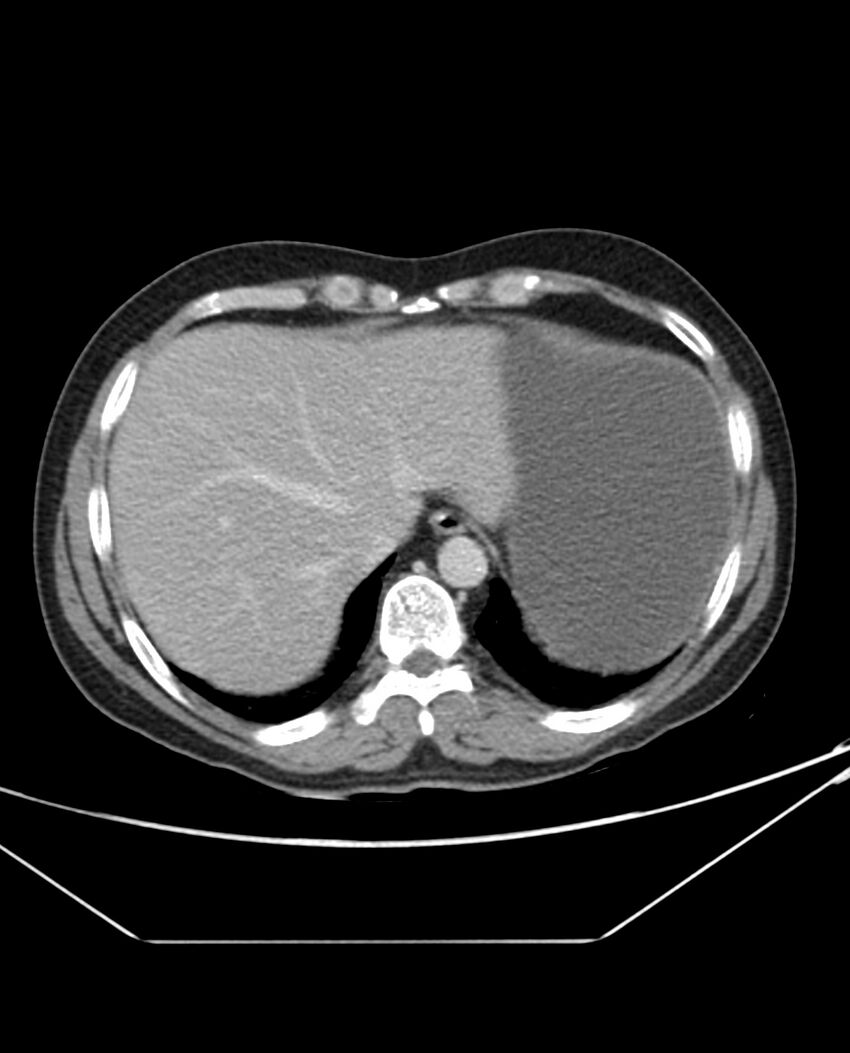 Arterial occlusive mesenteric ischemia (Radiopaedia 84641-100054 A 14).jpg