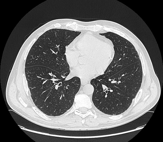 File:Asbestos pleural placques (Radiopaedia 57905-64872 Axial lung window 151).jpg