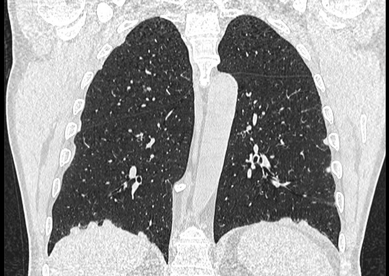 File:Asbestos pleural placques (Radiopaedia 57905-64872 Coronal lung window 199).jpg