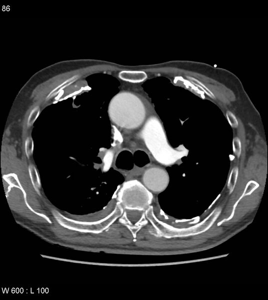 File:Asbestos related lung and pleural disease (Radiopaedia 14377-14301 D 22).jpg