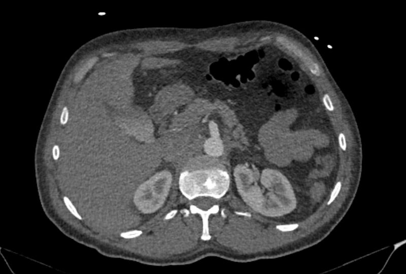 File:Ascending aortic aneurysm (Radiopaedia 86279-102297 C 73).jpg