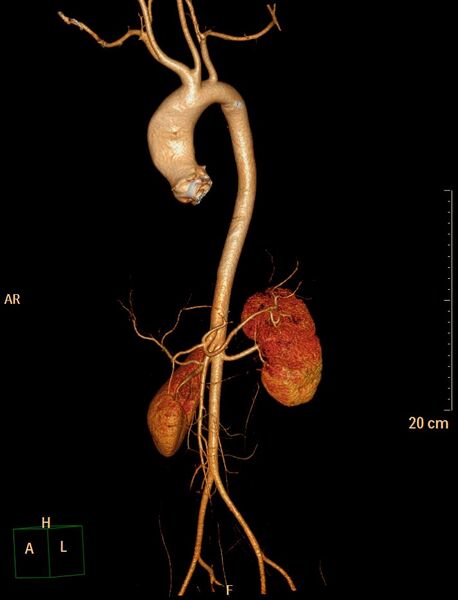 File:Ascending aortic pseudoaneurysm (Radiopaedia 28638-28910 D 30).jpg