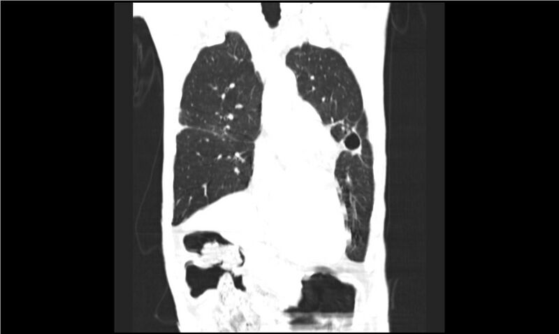File:Aspergilloma (Radiopaedia 20788-20701 Coronal lung window 5).jpg