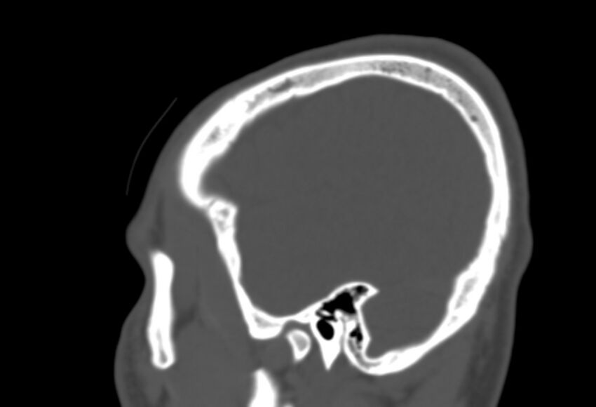 Asymptomatic occipital spur (Radiopaedia 87753-104201 Sagittal bone window 265).jpg