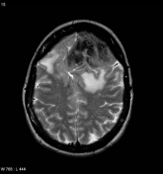 File:Atypical meningioma (WHO grade II) (Radiopaedia 7762-8586 Axial T2 7).jpg