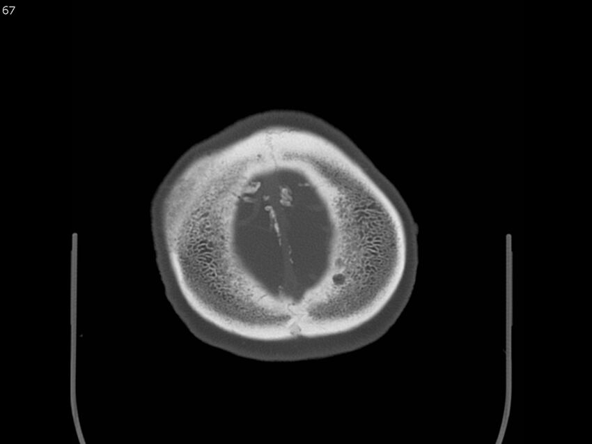 Atypical meningioma - intraosseous (Radiopaedia 64915-73867 Axial C+ bone window 67).jpg