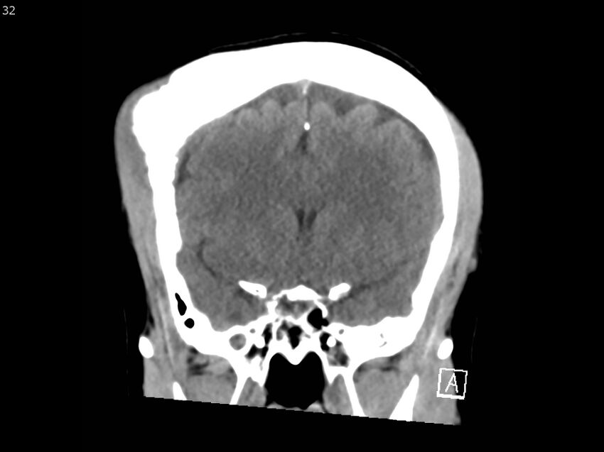 Atypical meningioma - intraosseous (Radiopaedia 64915-73867 B 31).jpg