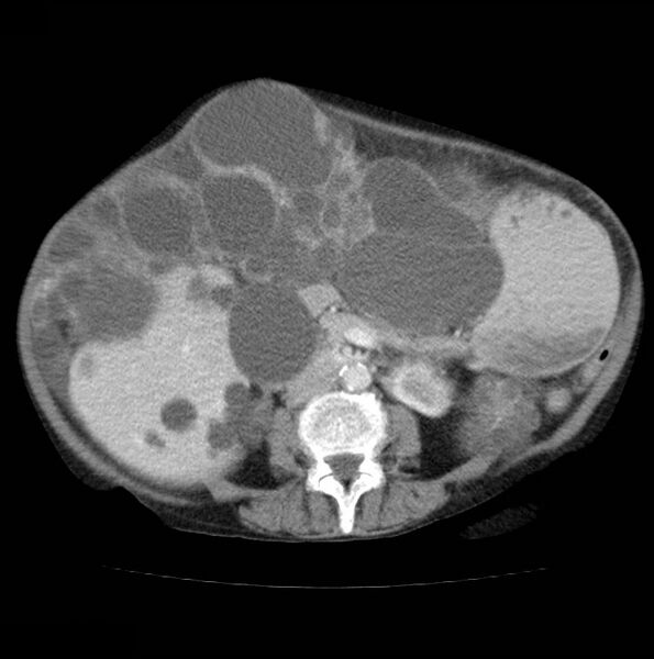 File:Autosomal dominant polycystic kidney disease (Radiopaedia 16777-16490 A 32).jpg