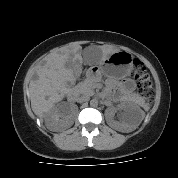 File:Autosomal dominant polycystic kidney disease (Radiopaedia 23061-23093 Axial non-contrast 23).jpg