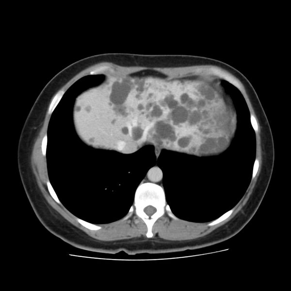 File:Autosomal dominant polycystic kidney disease (Radiopaedia 23061-23093 C 7).jpg