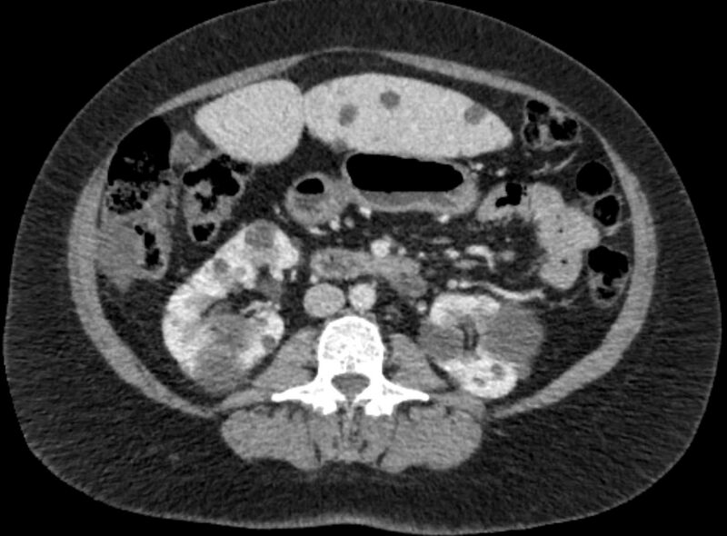 File:Autosomal dominant polycystic kidney disease (Radiopaedia 57124-64017 A 59).jpg