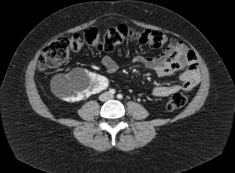 File:Autosomal dominant polycystic kidney disease (Radiopaedia 57124-64017 A 69).jpg