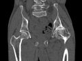 Avascular necrosis of the left hip (Radiopaedia 75068-86125 Coronal bone window 36).jpg