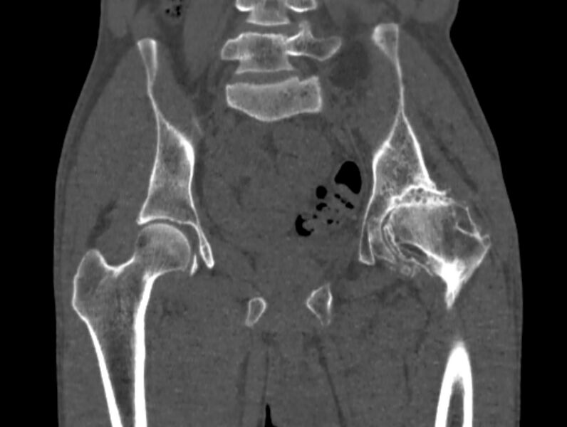 File:Avascular necrosis of the left hip (Radiopaedia 75068-86125 Coronal bone window 36).jpg