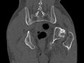 Avascular necrosis of the left hip (Radiopaedia 75068-86125 Coronal bone window 75).jpg