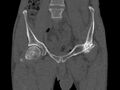 Avascular necrosis of the left hip (Radiopaedia 75068-86125 Coronal bone window 8).jpg