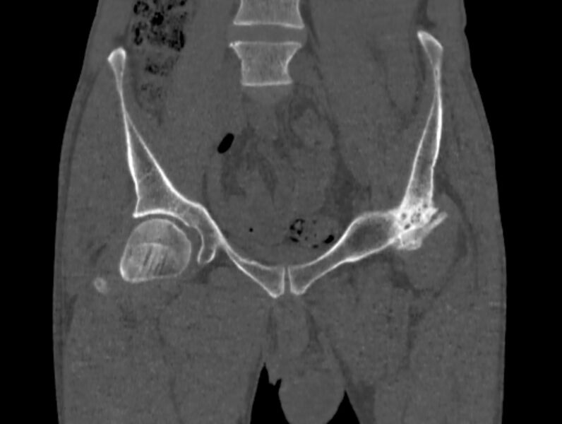File:Avascular necrosis of the left hip (Radiopaedia 75068-86125 Coronal bone window 8).jpg