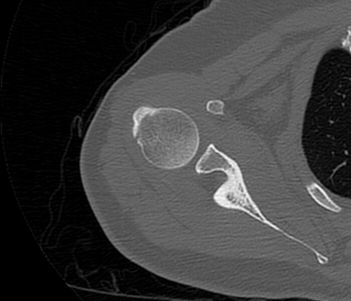 File:Avulsion fracture - greater tuberosity of humerus (Radiopaedia 71216-81514 Axial bone window 32).jpg