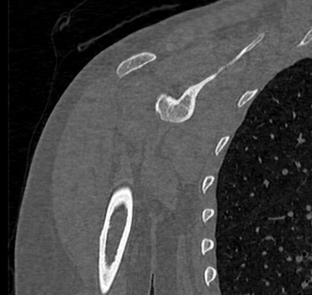 File:Avulsion fracture - greater tuberosity of humerus (Radiopaedia 71216-81514 Coronal bone window 39).jpg