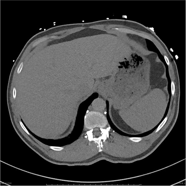 File:Azygos venous system anatomy (CT pulmonary angiography) (Radiopaedia 25928-26077 Axial C+ CTPA 81).jpg