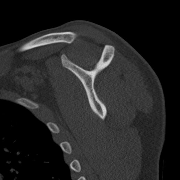 File:Bankart lesion (Radiopaedia 22771-22798 Sagittal bone window 39).jpg