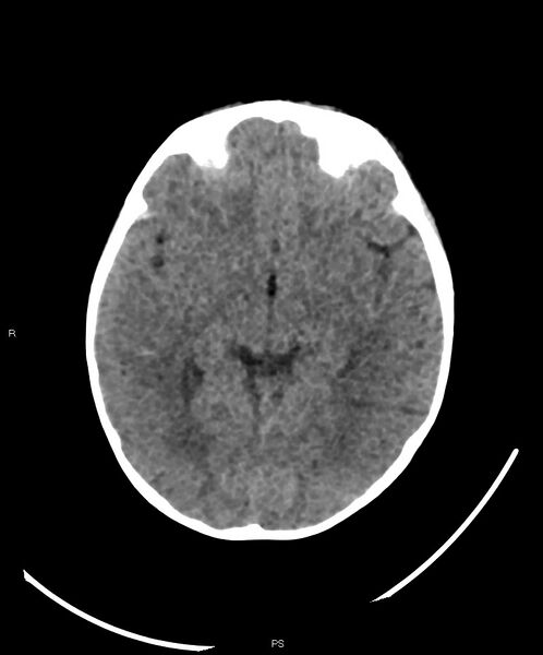 File:Basal ganglia and parenchymal ischemia (Radiopaedia 45818-50083 Axial non-contrast 25).jpg