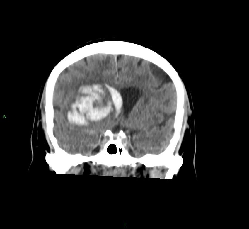 Basal ganglia hemorrhage (Radiopaedia 58763-65985 Coronal non-contrast 44).jpg