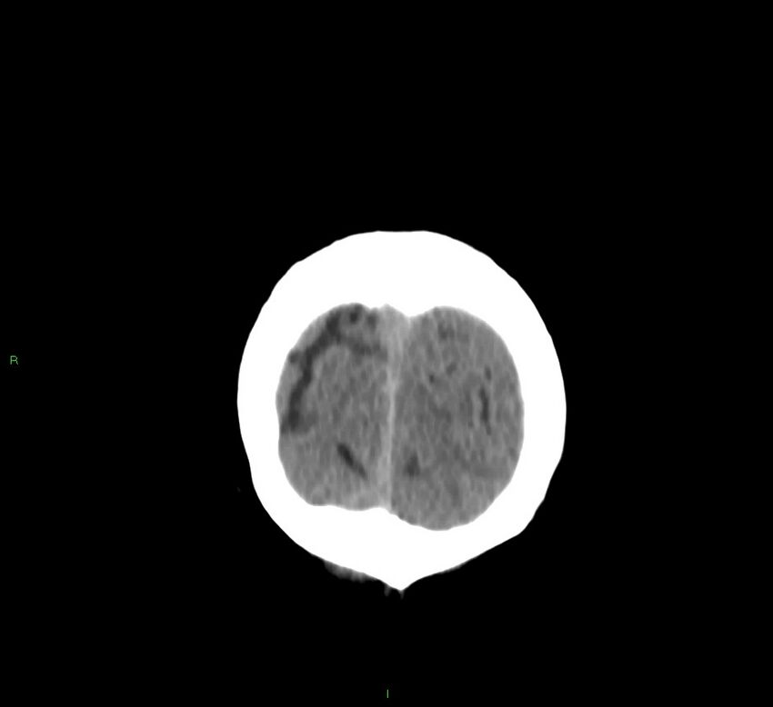 Basal ganglia hemorrhage (Radiopaedia 58767-65989 Coronal non-contrast 9).jpg