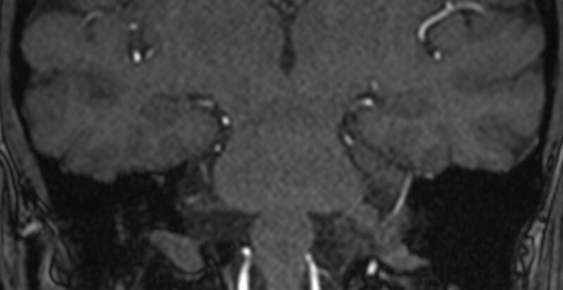 File:Basilar artery fenestration (Radiopaedia 74537-85455 Coronal MRA TOF 79).jpg