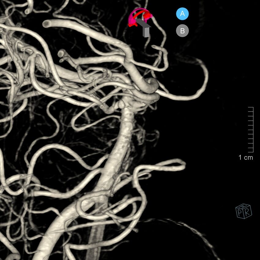 Basilar artery perforator aneurysm (Radiopaedia 82455-97734 3D view left VA 75).jpg