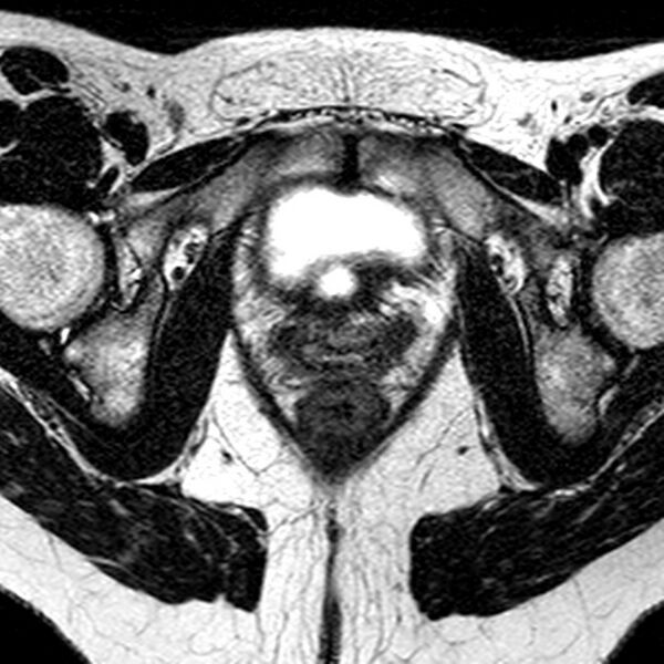 File:Bicornuate uterus (Radiopaedia 11104-11492 Axial T2 9).jpg