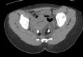 Bilateral mature cystic ovarian teratoma (Radiopaedia 88821-105592 Axial non-contrast 28).jpg