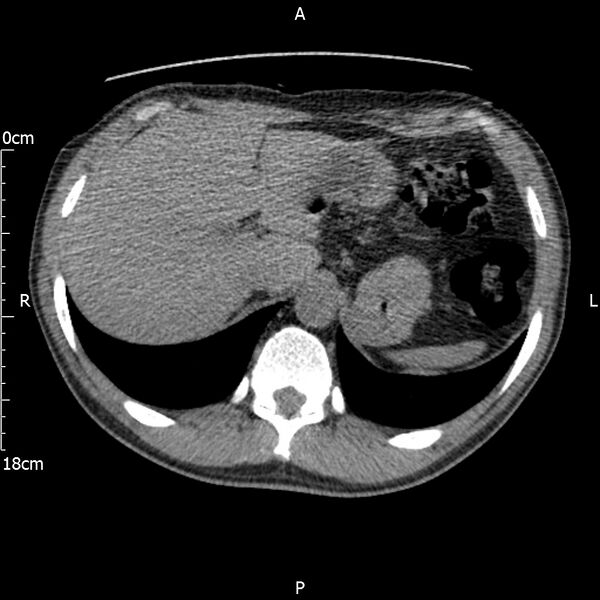File:Bilateral medullary nephrocalcinosis with ureteric calculi (Radiopaedia 71269-81569 Axial non-contrast 16).jpg