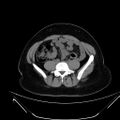 Bilateral ovarian mature cystic teratomas (Radiopaedia 79373-92457 Axial non-contrast 35).jpg